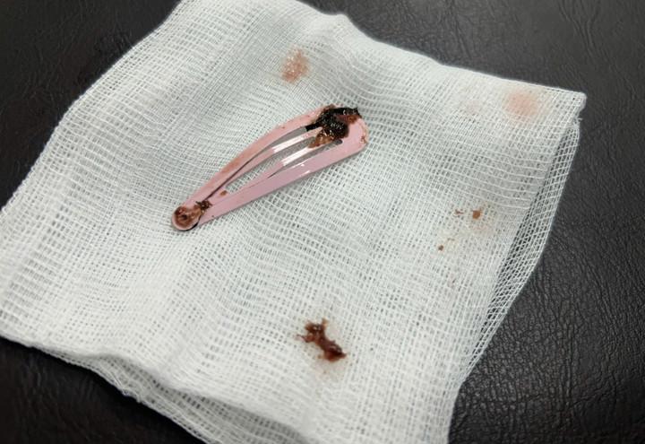 Gắp kẹp tóc dài 7cm khỏi dạ dày bé gái 6 tuổi- Ảnh 1.
