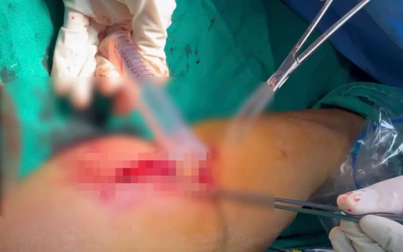 Cảnh báo áp xe sau tiêm truyền tại cơ sở không đảm bảo- Ảnh 1.
