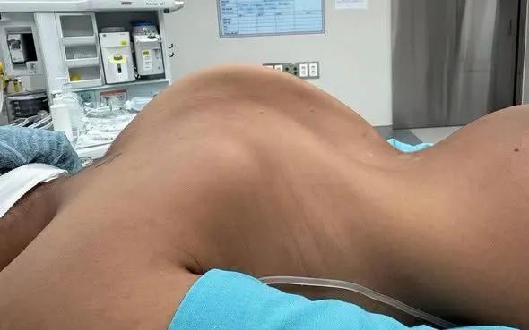 Phẫu thuật 2 trường hợp trẻ bị vẹo cột sống hiếm gặp- Ảnh 1.