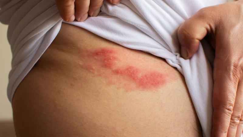 Đáng sợ cơn đau dai dẳng sau khỏi bệnh “giời leo”- Ảnh 1.