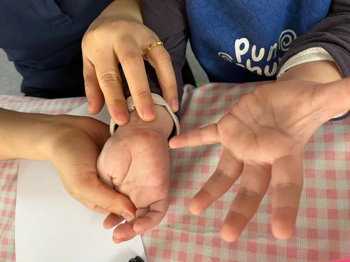 Tưởng con sốt phát ban, bà mẹ tá hỏa khi bác sĩ kết luận tay chân miệng- Ảnh 1.