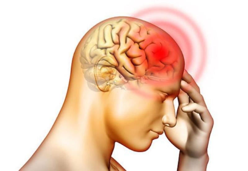 Đau đầu có thể không phải là dấu hiệu sớm nhất của xuất huyết não: Gặp 5 triệu chứng này cần đi viện ngay- Ảnh 3.