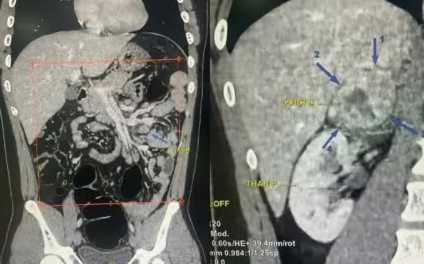 Tiểu hồng kéo dài, nam thanh niên 19 tuổi phát hiện u thượng thận 6 cm- Ảnh 1.