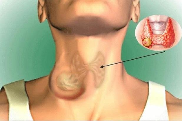 Đi khám được chẩn đoán u lành, sang nơi khác phát hiện có nhiều nhân ung thư tuyến giáp- Ảnh 1.