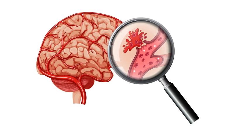 Đau đầu có thể không phải là dấu hiệu sớm nhất của xuất huyết não: Gặp 5 triệu chứng này cần đi viện ngay- Ảnh 1.