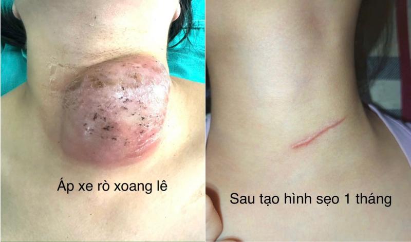 Phẫu thuật nội soi đóng rò xoang lê cho hàng chục trẻ em- Ảnh 1.