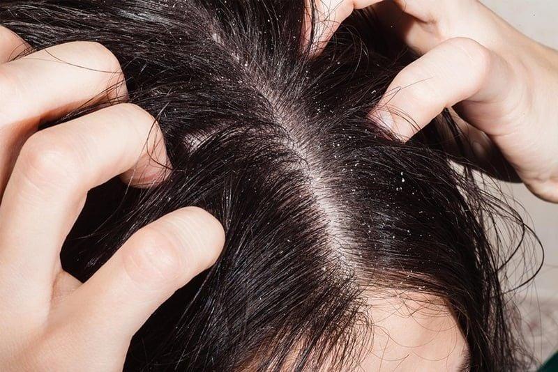 Mùa đông cứ làm 4 việc này, đừng hỏi sao mãi không hết gàu, còn làm tóc yếu và rụng nhiều hơn rõ, dùng thuốc xịn cũng chẳng bớt- Ảnh 1.