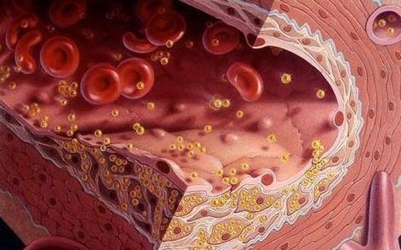 PGS Viện Dinh dưỡng Quốc gia: Đây là thói quen ăn uống khiến mỡ máu cao vút- Ảnh 1.
