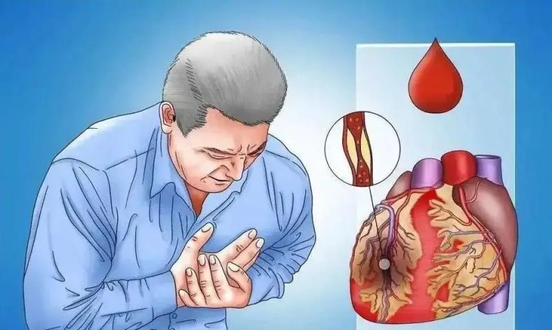 Nhiều ca nhồi máu cơ tim xảy ra đúng lúc này: 10 thời điểm tim dễ "gục" nhất, đáng tiếc nhiều người chủ quan bỏ qua- Ảnh 1.