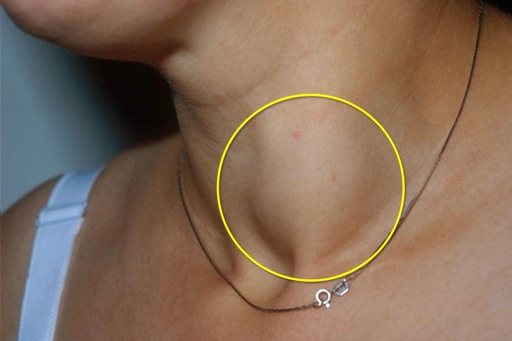 8 người một nhà cùng mắc ung thư tuyến giáp, bác sĩ nhắc nhở: Thấy 5 thay đổi này, e rằng "tế bào ung thư" đã lớn- Ảnh 2.