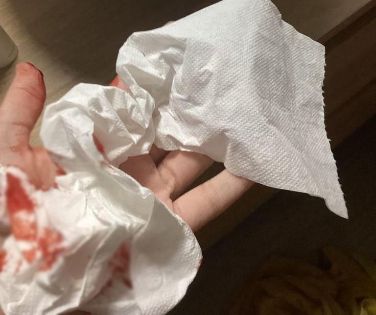 Nữ thư ký ngất xỉu khi đi vệ sinh, tưởng đột quỵ hóa ra suýt chết vì 