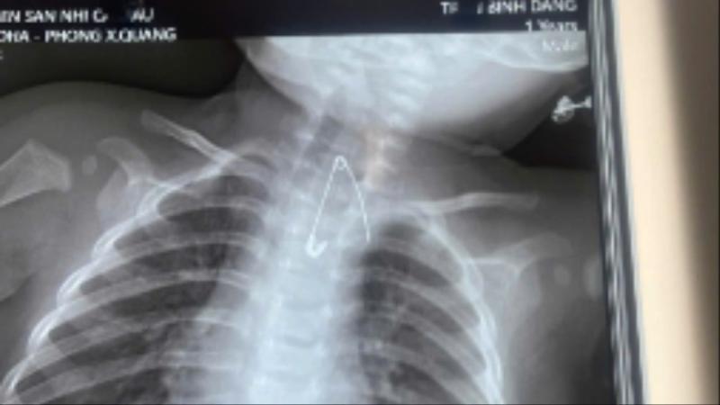 Trẻ bị thủng tá tràng vì nuốt que kẹo mút- Ảnh 1.