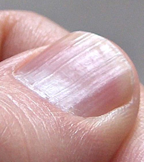 Móng tay nổi sọc dọc, cảnh báo dấu hiệu bất thường vấn đề sức khỏe- Ảnh 3.