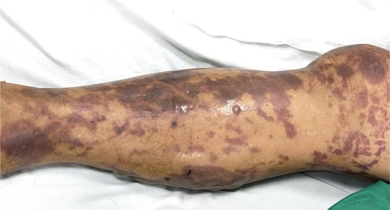 Người đàn ông 52 tuổi mắc phải bệnh truyền nhiễm nguy hiểm, lây lan nhanh và nguy cơ tử vong cao: Thủ phạm thực sự gây bất ngờ- Ảnh 3.