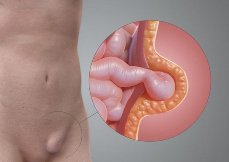 Bé gái quấy khóc vì khối phồng bẹn: Cảnh báo bố mẹ đừng chủ quan- Ảnh 1.