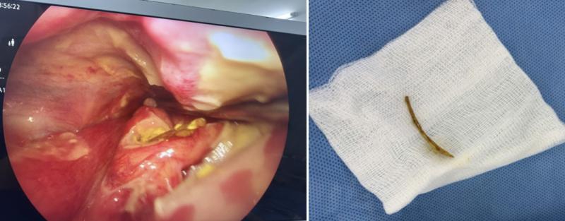 Ngậm viên sủi C để chữa hóc xương cá, người phụ nữ nguy kịch- Ảnh 1.