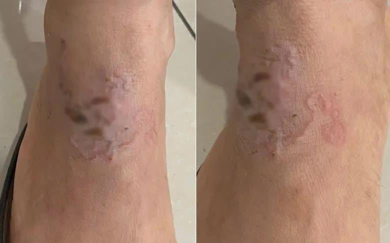 Ấu trùng "vẽ đường" ngoằn ngoèo dưới da người phụ nữ- Ảnh 1.