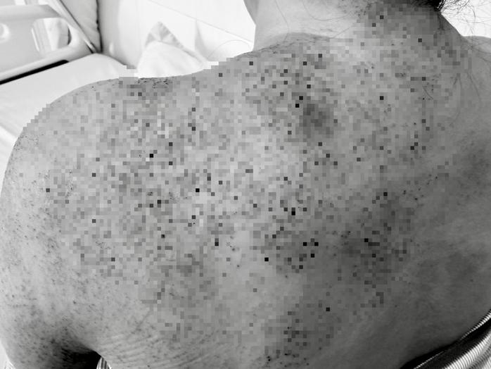 Người phụ nữ nhập viện cấp cứu sau khi chích lể, giác hơi- Ảnh 1.