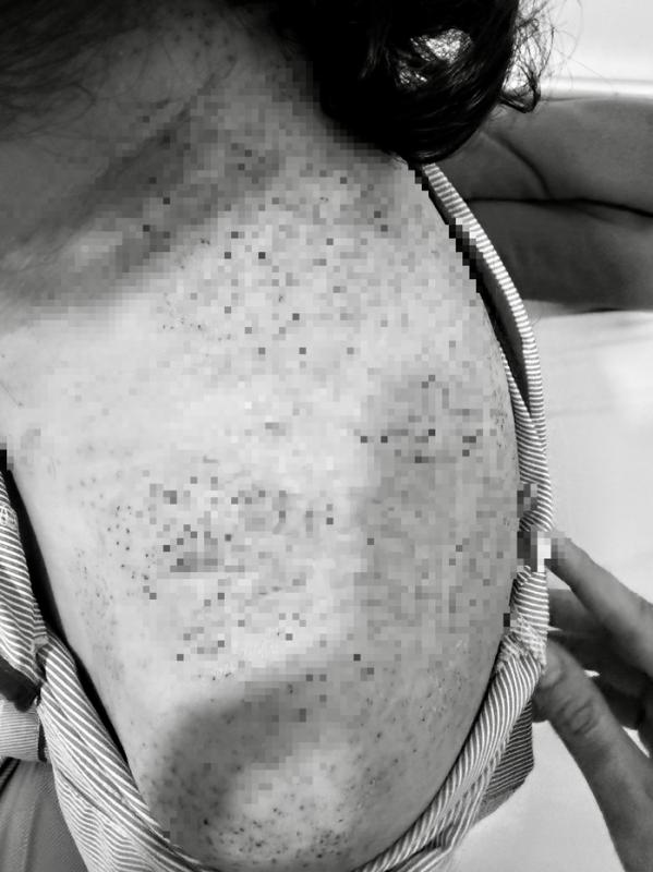 Người phụ nữ nhập viện cấp cứu sau khi chích lể, giác hơi- Ảnh 2.