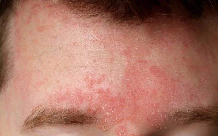 Những bệnh da thường gặp trong mùa lạnh- Ảnh 1.