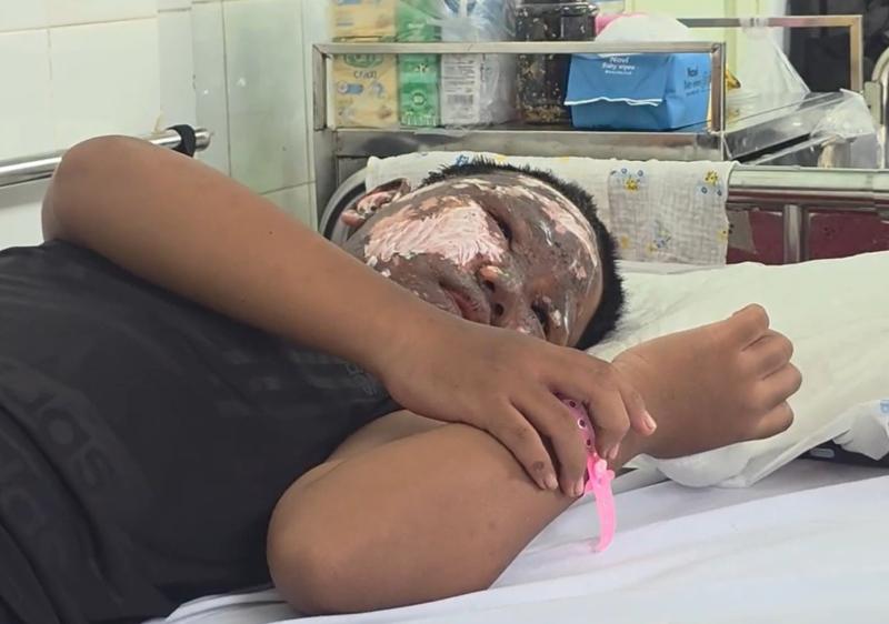 Chơi pháo nổ, bé trai bị tai nạn cháy đen khuôn mặt- Ảnh 1.