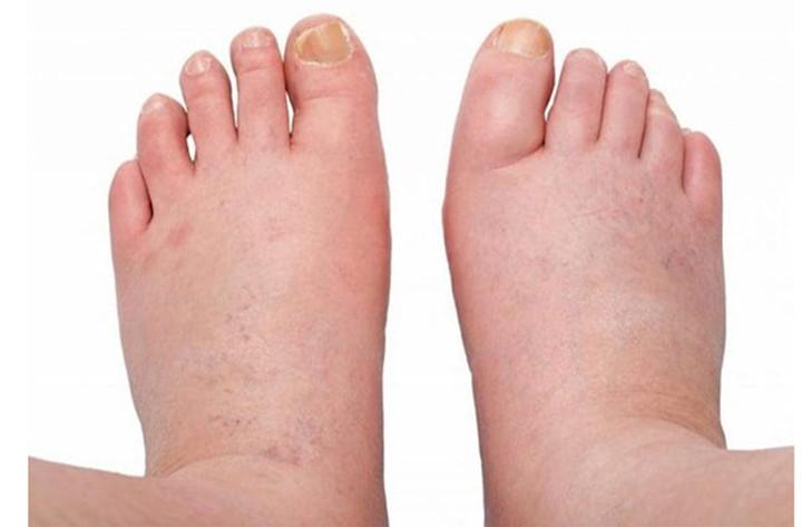 Bàn chân xuất hiện những dấu hiệu này, thận có thể đang 'kêu cứu'- Ảnh 1.