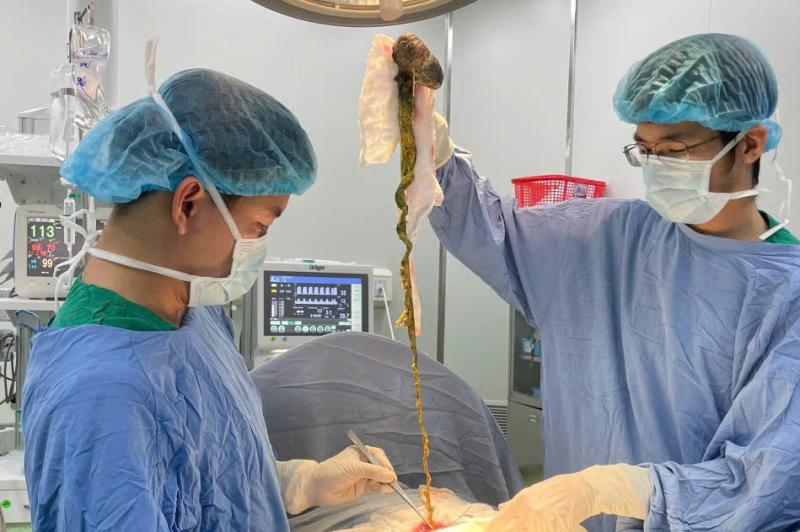 Bé trai phải lên bàn mổ vì ăn tóc, bác sĩ cảnh báo tình trạng y khoa hiếm gặp- Ảnh 1.