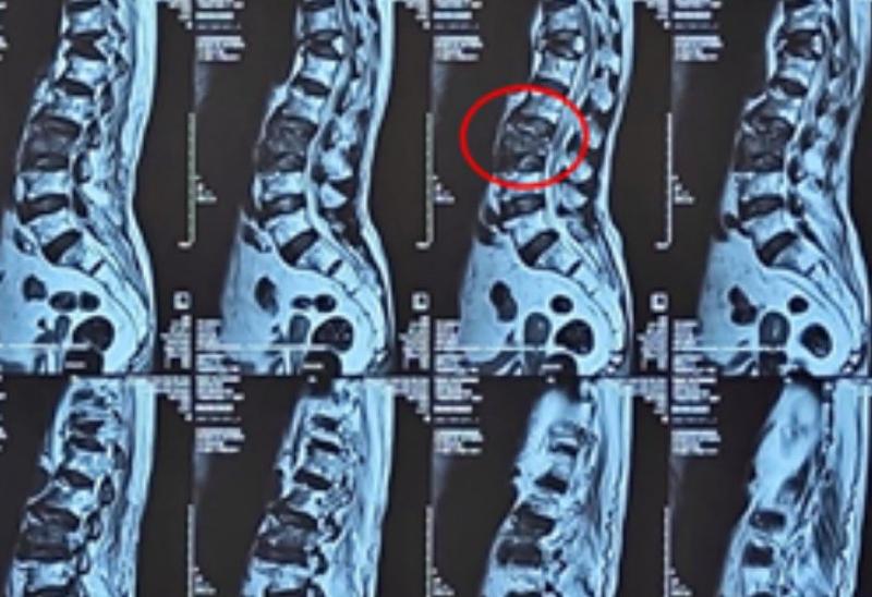Bơm ‘xi măng’ vào đốt sống cứu cụ bà 100 tuổi- Ảnh 1.