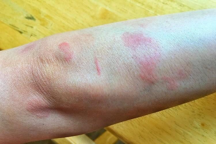 Cô gái Huế đột ngột qua đời trước ngày cưới nửa tháng do mắc bệnh lupus ban đỏ: Cảnh báo 1 nhóm phụ nữ nguy cơ cao mắc bệnh- Ảnh 2.
