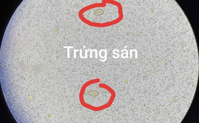 Đau bụng đi khám, người đàn ông 64 tuổi sốc ngang khi thấy ở sán trong người- Ảnh 1.