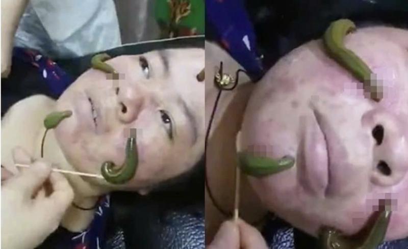 Ớn lạnh dùng đỉa hút mụn, bác sĩ cảnh báo hiểm họa- Ảnh 1.