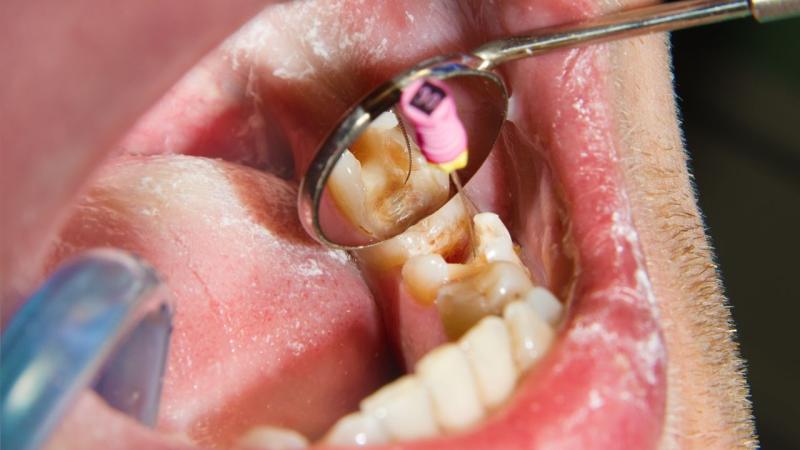Vụ bắt hơn 3.000 thuốc nha khoa chứa thạch tín: Giám đốc bệnh viện cảnh báo nguy cơ hoại tử xương hàm- Ảnh 1.