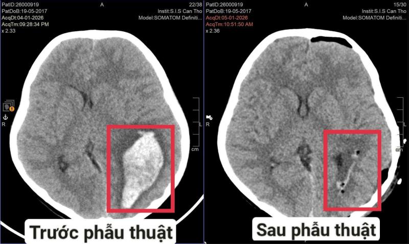 Bé trai mới 9 tuổi đã bị đột quỵ, bác sĩ cảnh báo dấu hiệu bất thường- Ảnh 1.