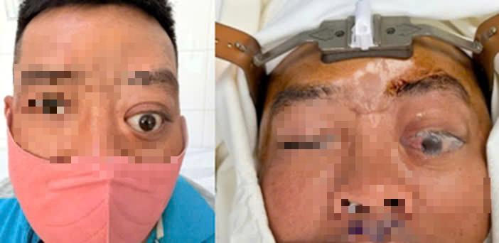 Một ca bệnh mà Bệnh viện Tai Mũi Họng TPHCM mới gặp lại trong vòng 20 năm- Ảnh 1.