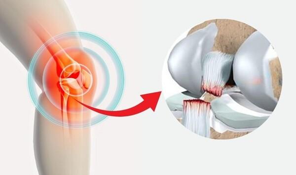Hiểu Minh bị đứt dây chằng chéo trước: Bác sĩ nói nếu làm được điều này sẽ phục hồi được 80% sau… 1 năm- Ảnh 3.