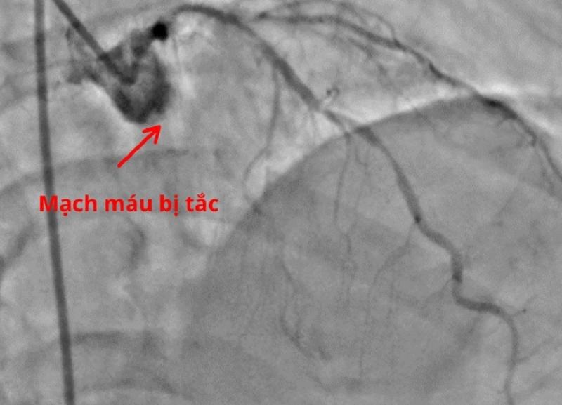 Chết lâm sàng vì bỏ qua dấu hiệu cảnh báo nhồi máu cơ tim cấp- Ảnh 1.