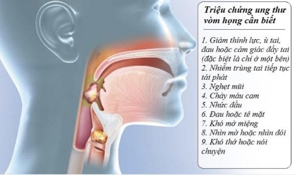 Cổ lên hạch tưởng bị viêm, người đàn ông bất ngờ phát hiện ung thư vòm họng giai đoạn 2: Các dấu hiệu hay bị xem thường- Ảnh 1.