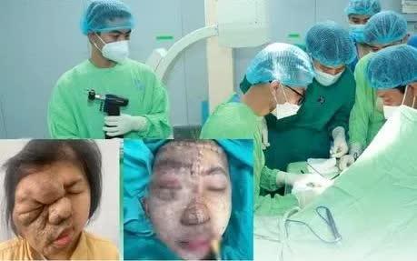 Phẫu thuật phức tạp tái tạo gương mặt cho cô gái 19 tuổi mang khối u suốt 17 năm- Ảnh 1.