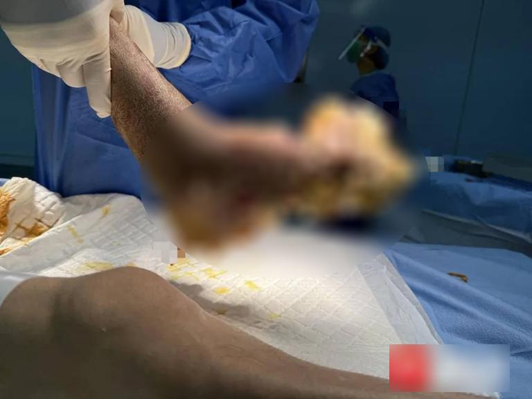 Người đàn ông suýt mất cả bàn chân vì nhiễm HPV- Ảnh 1.