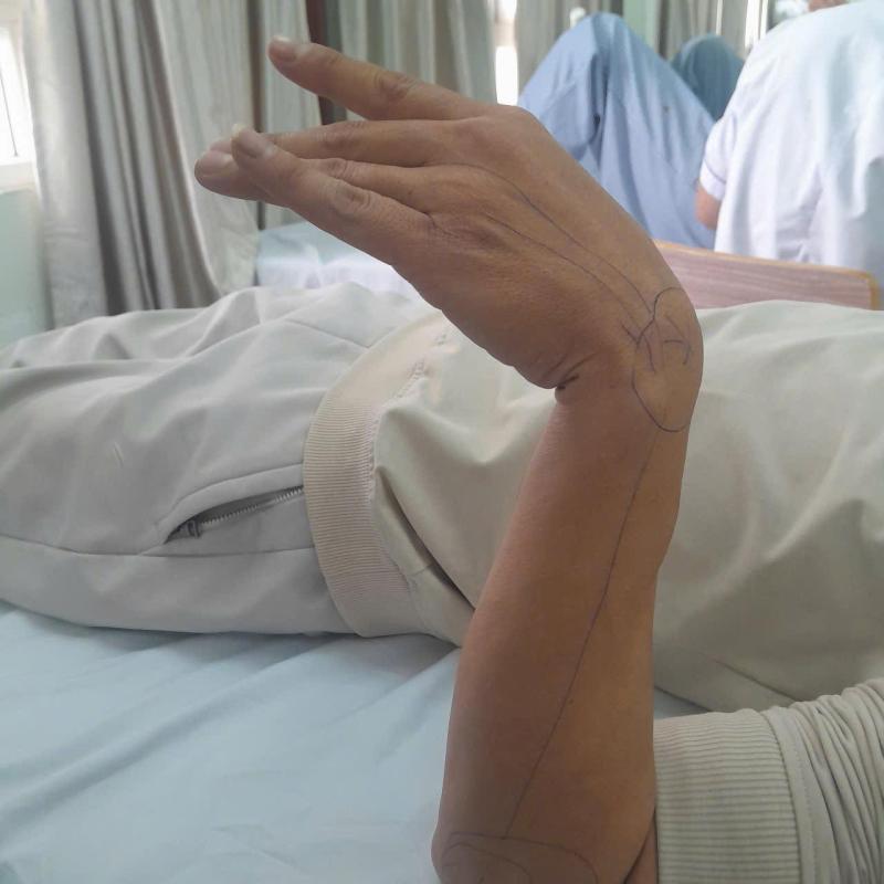 Ngủ gật 30 phút trong giờ làm, người đàn ông 37 tuổi bỗng liệt dây thần kinh, không nhấc nổi cổ tay- Ảnh 2.