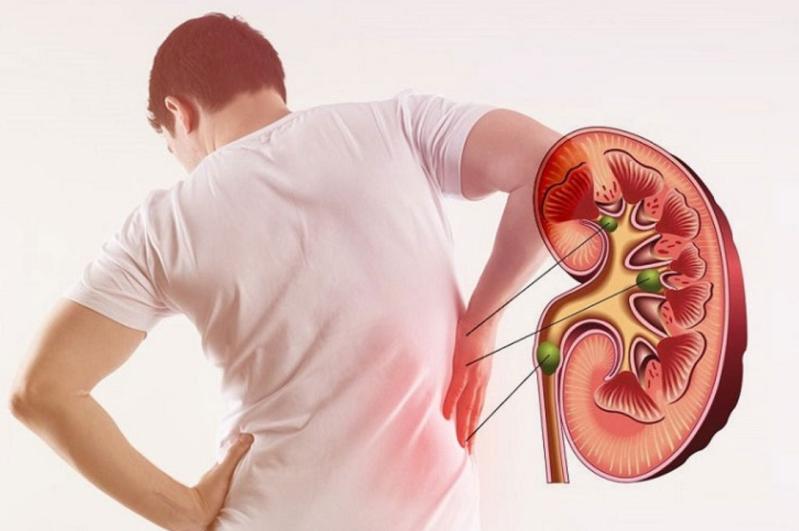 Hướng dẫn phân biệt màu nước tiểu khi thận suy?- Ảnh 2.
