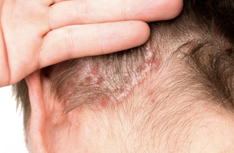 Bệnh tật bào mòn túi tiền của các gia đình: 6 căn bệnh hiện nay không thể chữa khỏi hoàn toàn!- Ảnh 2.