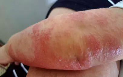Viêm da cơ địa mùa lạnh: Không chủ quan và tự ý điều trị- Ảnh 1.