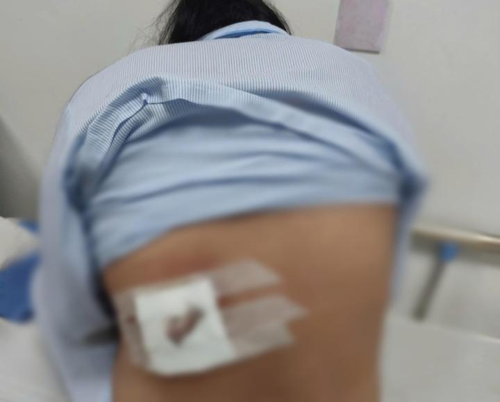 Đắp lá điều trị mụn lưng, người phụ nữ ở Quảng Trị bị hoại tử- Ảnh 1.