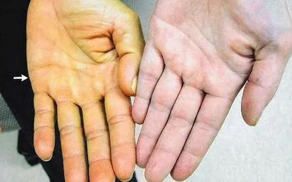 Suy gan cấp vì tự ý dùng thuốc nam không rõ nguồn gốc- Ảnh 1.