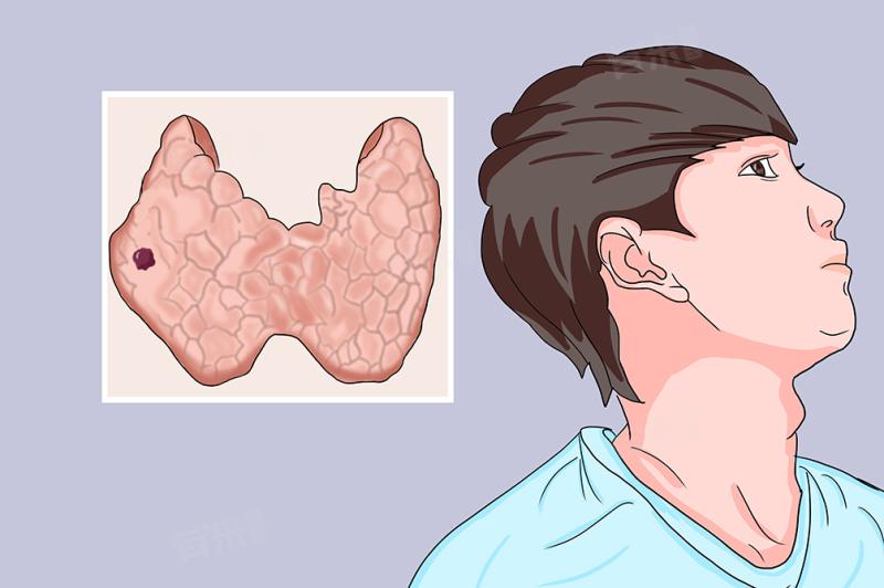 Nguyên nhân ung thư tuyến giáp ngày càng tăng nhưng giảm tỷ lệ tử vong- Ảnh 1.
