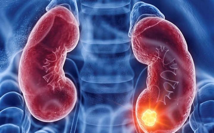 Ung thư thận dễ bị bỏ sót, chỉ phát hiện khi trong nước tiểu có máu- Ảnh 1.