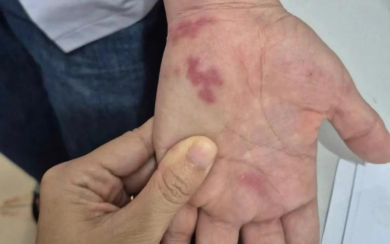 Nguy hiểm: Nhiễm vi khuẩn "ăn thịt người" sau khi bị vây cá đâm- Ảnh 1.