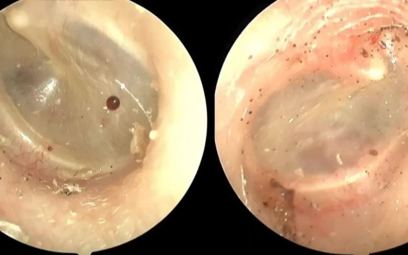 Đau, khó chịu tai kéo dài, phát hiện bọ chó sống trong tai- Ảnh 1.