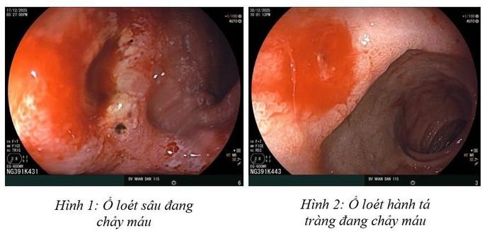 16 tuổi đã xuất huyết dạ dày và cảnh báo từ bác sĩ- Ảnh 2.